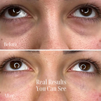 Vital Eye Pro  – Under-Eye Treatment for Puffiness & Bags